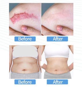 เครื่องอินดิบา เทคาร์ 448 กิโลเฮิรตซ์ สำหรับการเผาผลาญไขมันส่วนเกิน กระชับสัดส่วนด้วยคลื่นวิทยุ CET RET ความร้อนลึก ไดอะเทอร์มี เทคาร์ เครื่องเสริมความงาม - Product Image 6