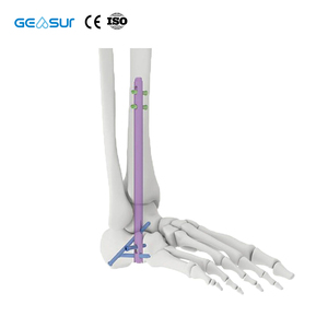 Paku Intramedullary Titanium Geasure 5.0/6.0 dengan Sekrup Pengunci - Kelas III Garansi 1 Tahun untuk Fiksasi Fraktur Tibia Pergelangan Kaki - Product Image 1