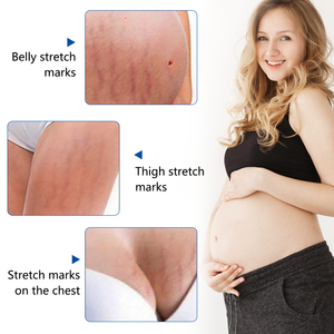 Minyak esensial penghilang Stretch Mark, minyak esensial Perawatan Kulit 100% organik Stretch Mark untuk kehamilan - Product Image 2