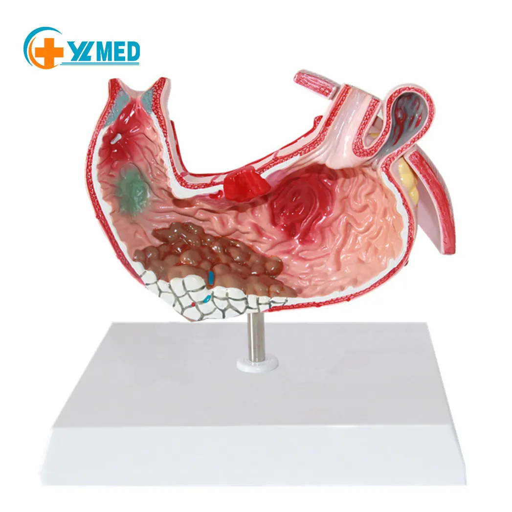 Modello anatomico dello stomaco di ricerca medica modello di malattia dello stomaco e dello stomaco patologico