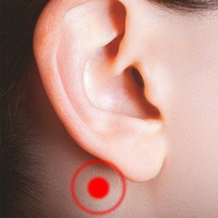 Patch de stimulation auriculaire personnalisable, transparent, hypoallergénique, pour le soulagement des acouphènes