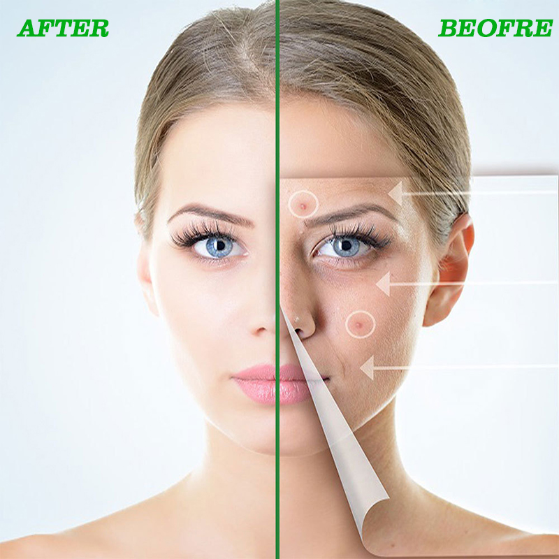 custom waterproof invisible ultra- thin hydrocolloid acne pimple spot patch adhesive blemish patch for acne healing