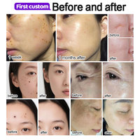 Stylo à plasma coréen pour lifting facial, élimination des taches et des grains de beauté, lifting des paupières, élimination des taches de rousseur, appareil de nettoyage en profondeur