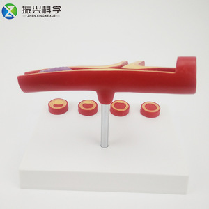Modelo de arteria en forma de Y con aterosclerosis y trombosis, modelo educativo, suministros del fabricante. - Product Image 2