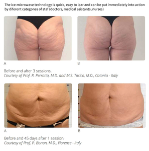 2026 New 500W ABS Burn Fat Excellence Face Lifting Remodelling Skin Tightening Body Forming Ice Microwave Fat Removal Machine - Product Image 5