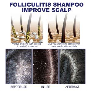 Shampooing personnalisé contre la dermatite séborrhéique shampooing antifongique pour le traitement <span class=keywords><strong>du</strong></span> <span class=keywords><strong>psoriasis</strong></span> et de la folliculite <span class=keywords><strong>du</strong></span> <span class=keywords><strong>cuir</strong></span> <span class=keywords><strong>chevelu</strong></span> - Product Image 4