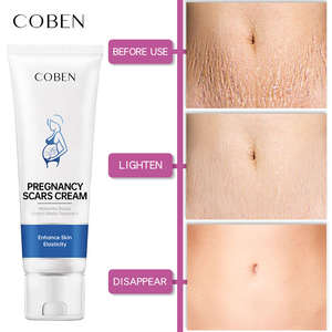 100% naturale vegano Anti-Acne post-partum cicatrice premaman <span class=keywords><strong>per</strong></span> la rimozione della cura della pelle <span class=keywords><strong>crema</strong></span> <span class=keywords><strong>per</strong></span> le smagliature <span class=keywords><strong>per</strong></span> pancia, tette, fianchi e cosce - Product Image 4