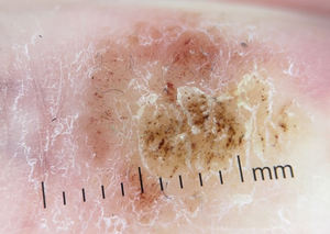 IBOOLO DE4100 PRO serviço personalizado livre Dermoscope maior visão para olhos nus Examine - Product Image 6