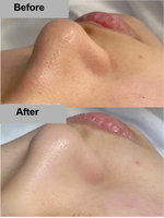 Appareil de soin du visage à jet d'eau hydrogénée, nettoyage en profondeur des pores, brume nano pour une absorption accrue, éclaircissement et hydratation de la peau