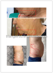 Máquina de Láser Diodo 980 1470nm para Reafirmar el Rostro, Lifting Endolaser, Moldear el Cuerpo, Liposucción, Eliminación de <span class=keywords><strong>Celulitis</strong></span> - Product Image 5
