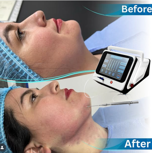 Máquina de Estiramiento Facial Endolaser, Liposucción, Láser de Diodo de 1470nm y 980nm, Fibra Óptica Desnuda, Dispositivo Endoskin, Estiramiento Facial Profesional - Product Image 1