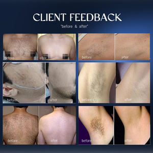 Ares Smart Diode Laser 755 808 1064 Nouvelle Machine d'épilation laser à diode portable - Product Image 5