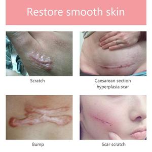 Hot bán Y Tế cấp tái sử dụng tấm Silicone sẹo vá Remover <span class=keywords><strong>Stretch</strong></span> Mark cho đồ lót vết rạn da - Product Image 2