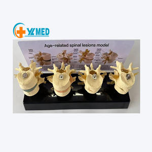 Vertebra lombare malata modello di ernia disco osteoporosi insegnamento ortopedico umano modello di comunicazione medico-paziente - Product Image 1