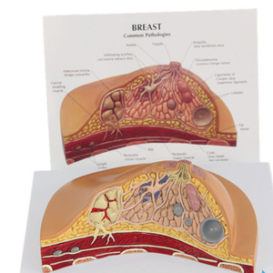 نموذج سرطان الثدي الأنثوي بالحجم الطبيعي نموذج فحص الثدي المرضي للإناث نماذج تشريحية للتعليم الطبي - Product Image 3