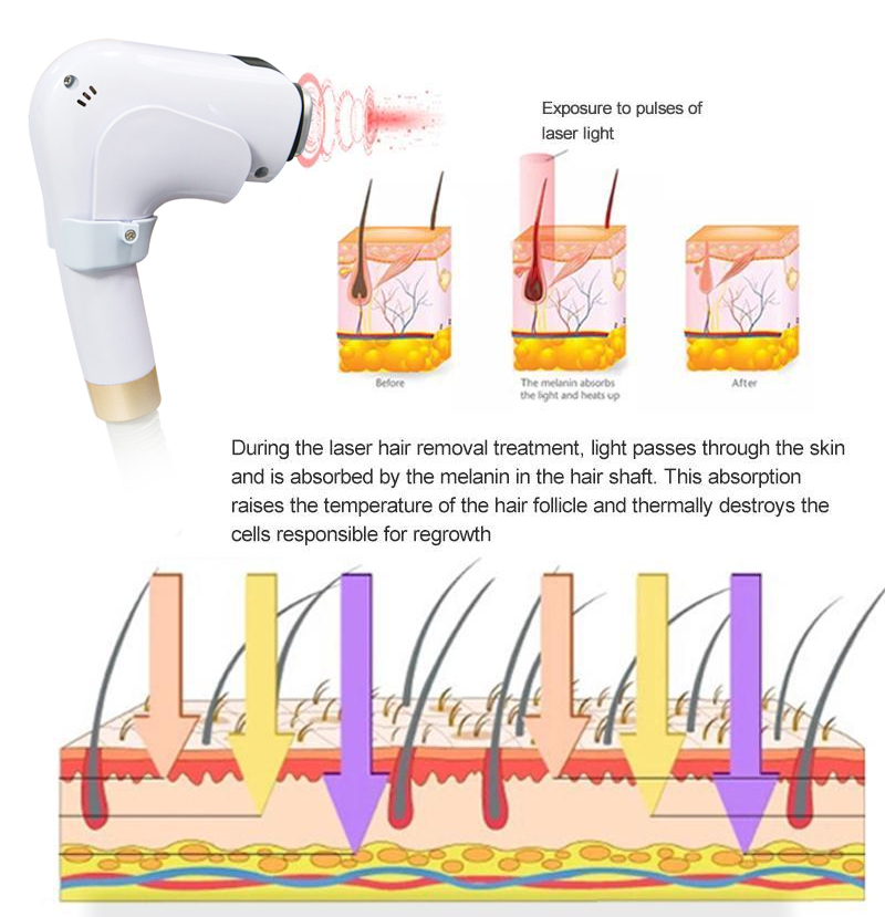 Diode Laser Hair Removal Machine Ice Platinum Epilator Diode Laser 755 808 1064