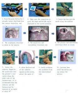 कम लागत में एनेस्थीसिया वीडियो लैरीगॉस्कोप/पुनः प्रयोज्य वीडियो स्वरकोस्कोप - Product Image 6