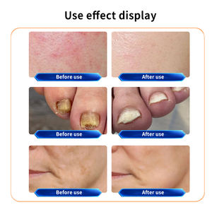 New Arrival Diode <strong>Laser</strong> 980 nm Spider Vein Removal Blood Vessels Removal Fungus Nail Fungus <strong>Treatment</strong> Machine for Beauty Salon - Product Image 3