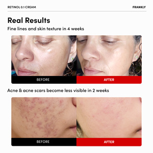 ครีมเรตินอลเข้มข้น FRANKLY Retinol 0.3% บำรุงผิวอย่างล้ำลึก ช่วยฟื้นฟูผิวกระชับ ลดเลือนริ้วรอยและปัญหาสิว - Product Image 5