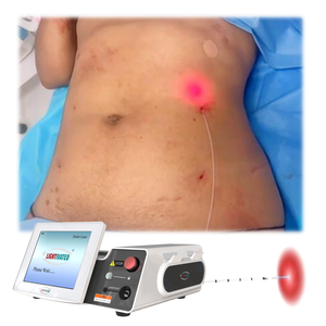 Máquina de Lipólisis Láser ENDOPLUSE del Reino Unido, 30w 980nm, Lipo Láser para Pérdida de Peso, Diodo Láser, <span class=keywords><strong>Liposucción</strong></span> Endoláser, <span class=keywords><strong>Precio</strong></span> de Fábrica, Máquina de Estiramiento Facial - Product Image 1