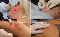 Remplissage des fesses, lifting du visage, liposuccion par canule BBL, Endolaser 980nm pour la dissolution des graisses, élimination de la peau relâchée, anti-cellulite, élimination des rides 1470nm