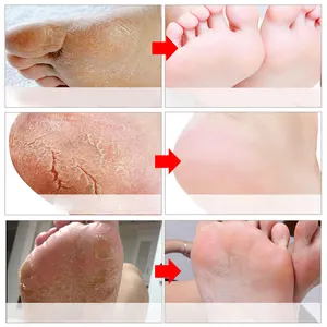 Powerful Offer Skin Exfoliating Foot Chemical Peel Off Mask