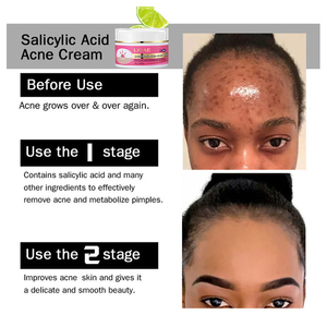 Crème Visage Anti-Acné LKIAE Soin Naturel Contrôle du Sébum Rafraîchissante Réduit les Points Noirs et les Boutons <span class=keywords><strong>Acide</strong></span> <span class=keywords><strong>Salicylique</strong></span> Raffermissante Éclaircissante - Product Image 6
