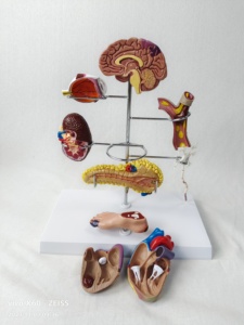 Modelo de Enseñanza de Anatomía Humana para Ciencias Médicas: Pie Diabético para Educación en Endocrinología y Patofisiología, Escuela de Medicina - Product Image 5
