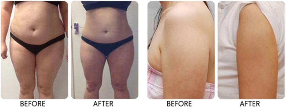 2022 2 Handle Dual Control 7D Hifu Machine For Skin Tightening And Body Slimming