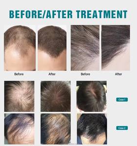 מכירה ישירה במפעל 208 דיודות לייזר קסדת צמיחת שיער בלייזר כובע צמיחת שיער - Product Image 2