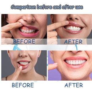 Spray Herbal ORALHOE pour Soulager les Maux de Dents, Éliminer la Congestion, Prévenir les Saignements des Gencives, Soulager la Douleur et Réparer les Gencives Abîmées - Product Image 2