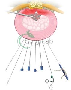 Intervertebral disk kanülü sistemi için tek kullanımlık perkutan dissektomi kanül kiti - Product Image 6