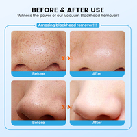 Appareil de nettoyage des pores du visage rechargeable à 6 têtes d'aspiration, outil de nettoyage en profondeur des pores, aspirateur de points noirs, machine d'élimination des comédons