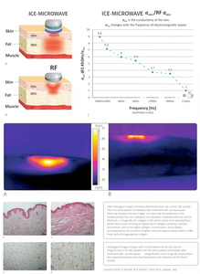 Máquina Onda Coolwaves 2.45Ghz para Eliminación de Celulitis, Eliminación de Arrugas, Rejuvenecimiento de la Piel, Tecnología de Hidrodermoabrasión, Bola Facial - Product Image 3