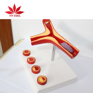 Anatomie humaine Artère et vaisseaux sanguins athérosclérose Modèle de <span class=keywords><strong>pathologie</strong></span> thrombus médical - Product Image 4