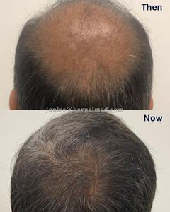 Dispositivos para el Crecimiento del Cabello Kernel, <span class=keywords><strong>Casco</strong></span> Láser para el Crecimiento del Cabello, <span class=keywords><strong>Casco</strong></span> de Terapia de Luz Infrarroja, Gorra de Luces Láser LLLT para la Pérdida de Cabello - Product Image 4