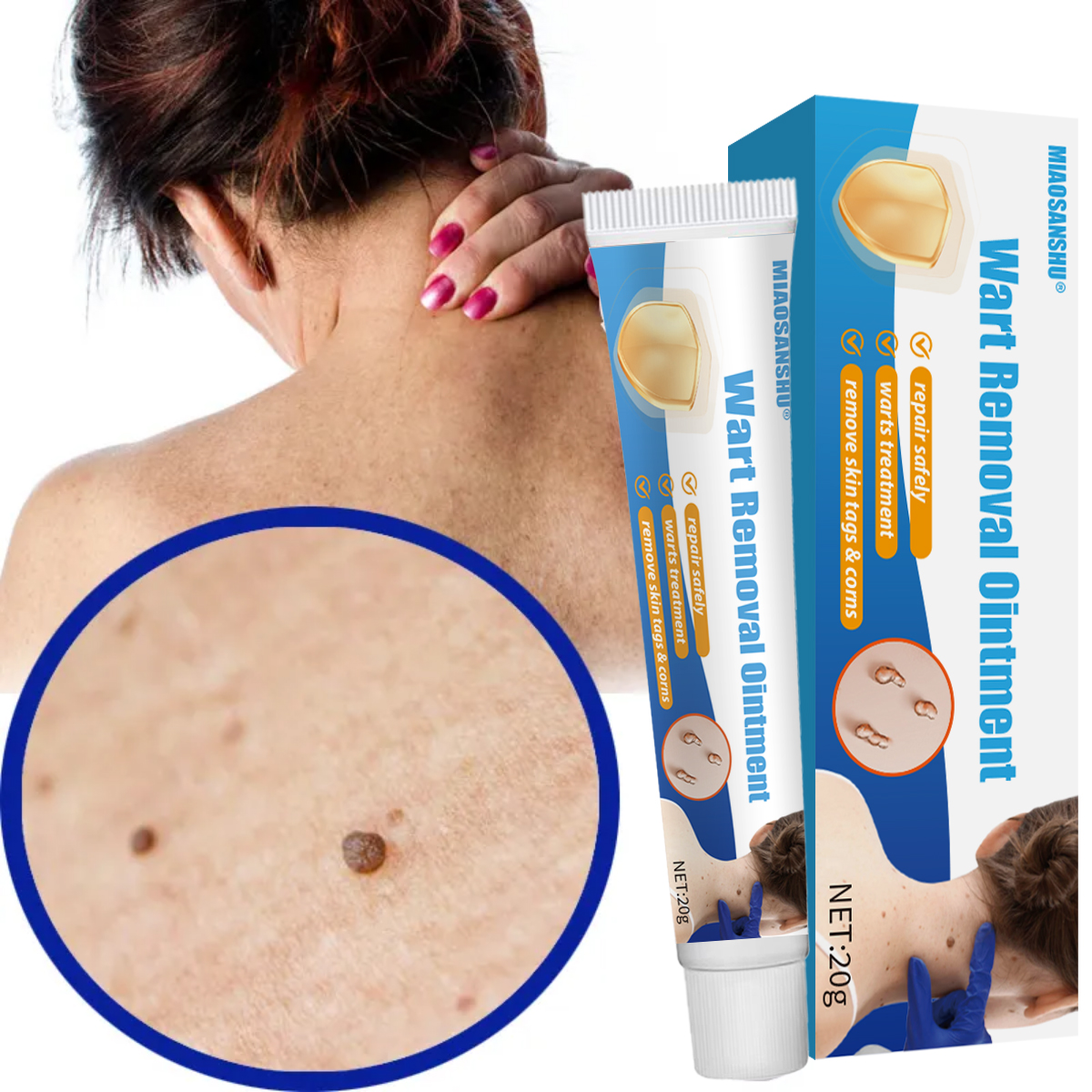 OEM/ODM Skin Care Wart Removal Cream Gentle and Non-Irritating for Hands, Feet and Face Leaves No Trace