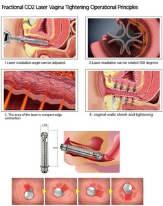 Hàn Quốc y tế CO2 Laser văn phòng phẩm phong cách <span class=keywords><strong>fractional</strong></span> tần số vô tuyến cho khuôn mặt và cơ thể phương pháp điều trị - Product Image 6