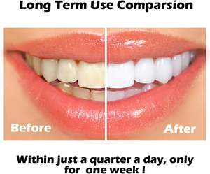 2025 Kit de blanchiment des dents sans fil rechargeable sans peroxyde sans fil à rayons rouges et bleus - Product Image 3