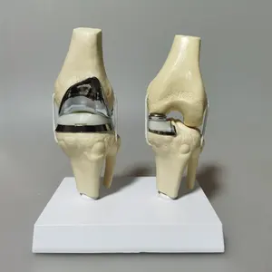 KyrenMed Detachable Artificial Knee Prosthesis Model Knee Joint Implant Model Set