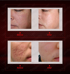 2025 Sản phẩm mới fractional CO2 <span class=keywords><strong>Laser</strong></span> Skin <span class=keywords><strong>Resurfacing</strong></span> & Thắt chặt âm đạo xách tay cường độ cao CE Máy - Product Image 6