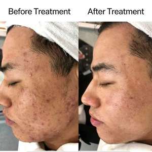 เซรั่มบำรุงผิวหน้า OEM สูตรเกาหลี BHA ลด<span class=keywords><strong>สิว</strong></span> รักษาสิว ด้วยกรดอะซีเลอิกและกรดซาลิไซลิก ผลิตภัณฑ์ทำความสะอาดผิวหน้า ลดรอยสิวและสิว<span class=keywords><strong>อักเสบ</strong></span> - Product Image 3