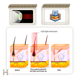 Épilateur LED vertical professionnel indolore et permanent pour salon de beauté avec assistance technique OEM ODM - Product Image 6