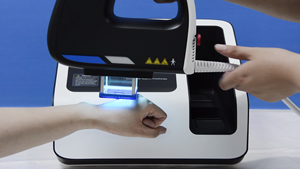 Kernel KN 5000C Haute Puissance 50mW 308nm Excimer Laser Phototherpay Système Laser Traitement Ciblé du Psoriasis <span class=keywords><strong>Vitiligo</strong></span> - Product Image 5