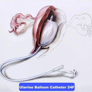 Suministro Médico: Balón de Hemostasia Postparto Esterilizado con Epoxi y Etano de 24fr con Instilación Rápida para Control Temporal - Product Image 5