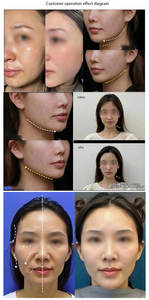 Dispositivo de Belleza Doble Acción Reafirmante y Lifting Antienvejecimiento para Rostro y Cuerpo para HIFI - Product Image 6