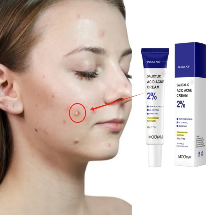 Salicylic Acid Acne Removal Facial Cream Smoothing Deep Moisturizing Natural Skin Care Products MOOYAM Acne Face Cream