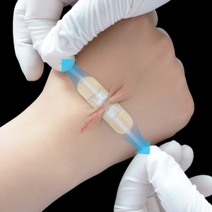 Transparente Zip ponto suturas Kit ataduras com zíper borboleta pele cirúrgica ferida encerramento dispositivo Band Aid Patch - Product Image 6