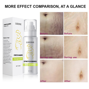 Phụ nữ mang thai chống rạn da loại bỏ kem nhãn hiệu riêng hiệu quả mạnh mẽ rạn da loại bỏ kem cho cơ thể chân - Product Image 4