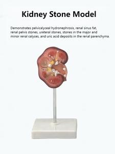 Modèle pédagogique de calcul rénal pour l'enseignement en urologie - Product Image 5